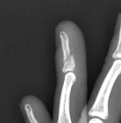 Distal Phalanx Fracture 2